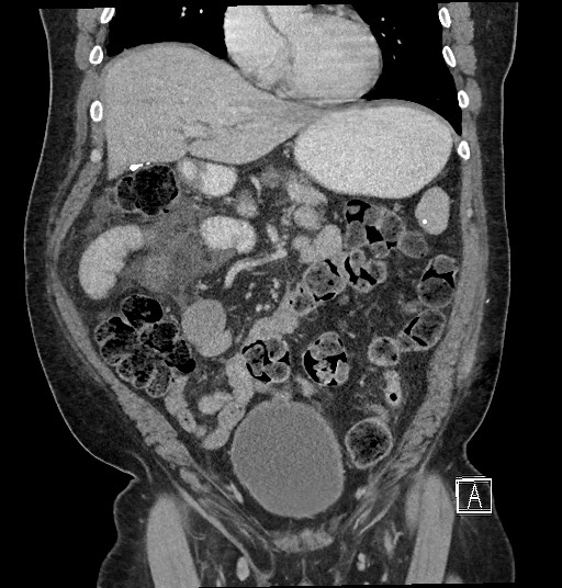 File:Closed loop obstruction - internal hernia into nephrectomy bed (Radiopaedia 59867-67320 B 50).jpg
