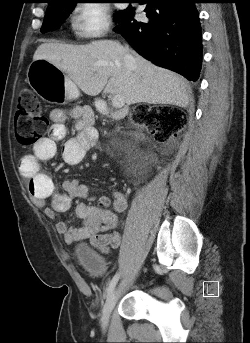 Closed loop obstruction - internal hernia into nephrectomy bed (Radiopaedia 59867-67320 C 62).jpg
