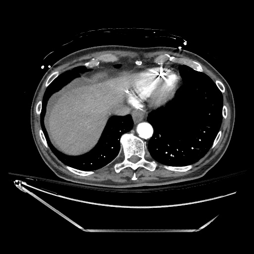File:Closed loop obstruction due to adhesive band, resulting in small bowel ischemia and resection (Radiopaedia 83835-99023 B 20).jpg