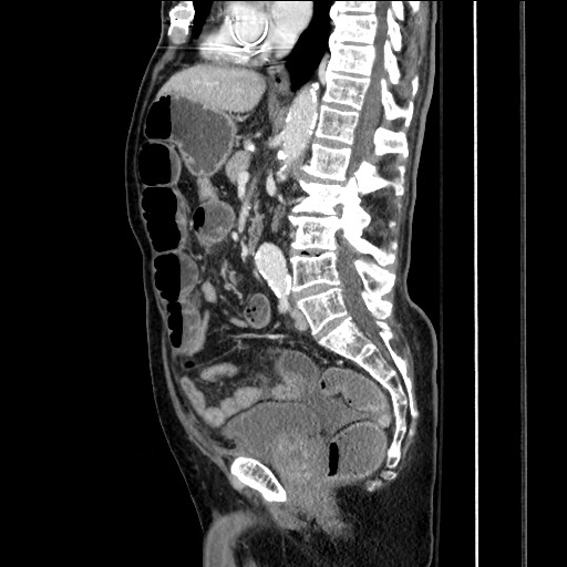 File:Closed loop obstruction due to adhesive band, resulting in small bowel ischemia and resection (Radiopaedia 83835-99023 F 100).jpg