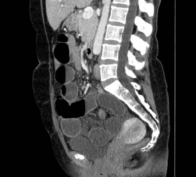 Closed loop small bowel obstruction (Radiopaedia 71211-81508 C 74).jpg