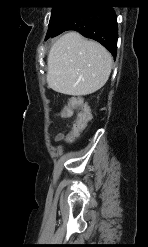 Closed loop small bowel obstruction - adhesions (Radiopaedia 59269-66611 C 93).jpg
