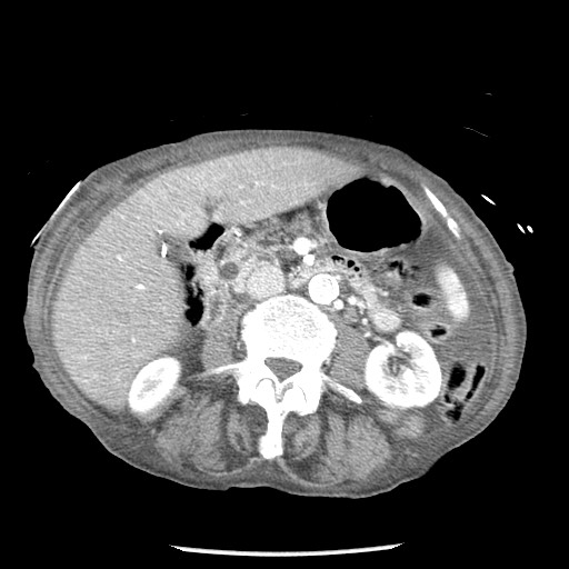 Closed loop small bowel obstruction - adhesions and infarct (Radiopaedia 85125-100678 B 43).jpg