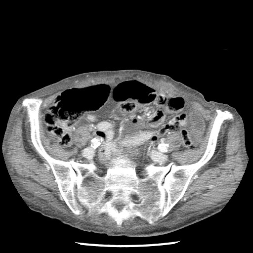 Closed loop small bowel obstruction - adhesions and infarct (Radiopaedia 85125-100678 B 72).jpg