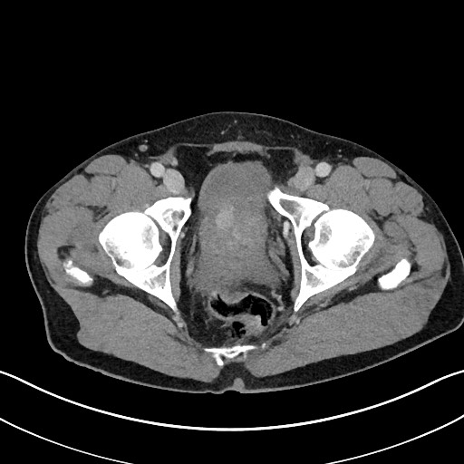 File:Closed loop small bowel obstruction - internal hernia (Radiopaedia 57806-64778 Axial 90).jpg