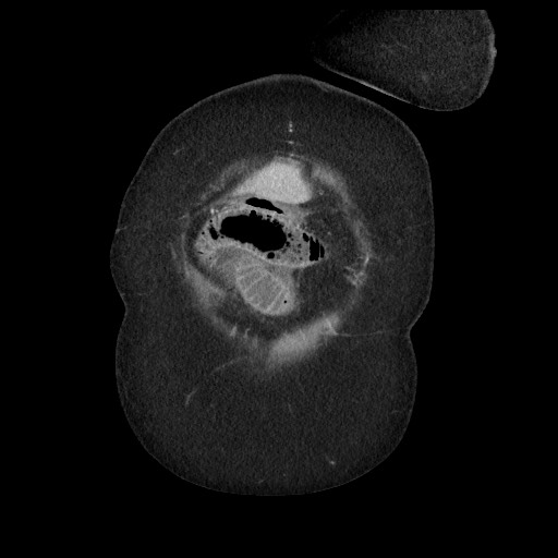 Closed loop small bowel obstruction - internal hernia (Radiopaedia 65402-74450 B 11).jpg