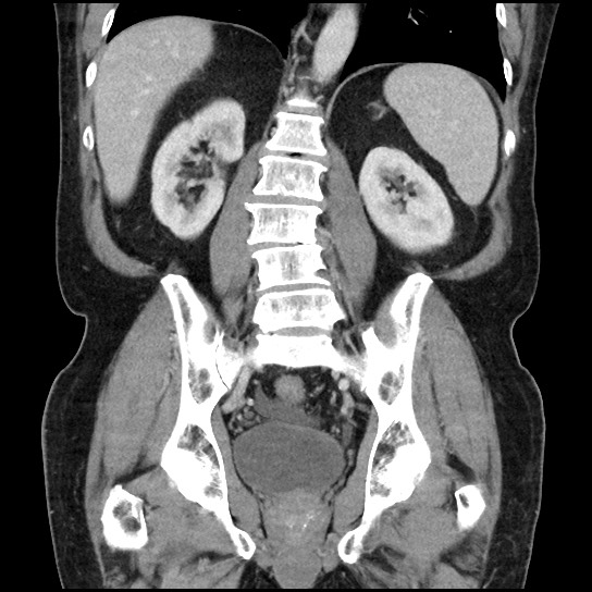 File:Closed loop small bowel obstruction due to adhesive band - U-shaped loop (Radiopaedia 83829-99012 B 34).jpg