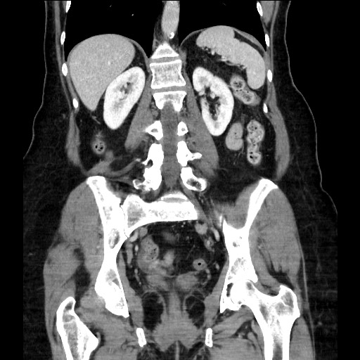 Closed loop small bowel obstruction due to adhesive bands - early and late images (Radiopaedia 83830-99014 B 84).jpg