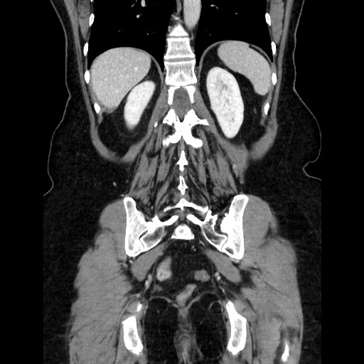 File:Closed loop small bowel obstruction due to adhesive bands - early and late images (Radiopaedia 83830-99015 B 93).jpg