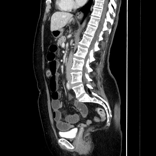Closed loop small bowel obstruction due to adhesive bands - early and late images (Radiopaedia 83830-99015 C 89).jpg