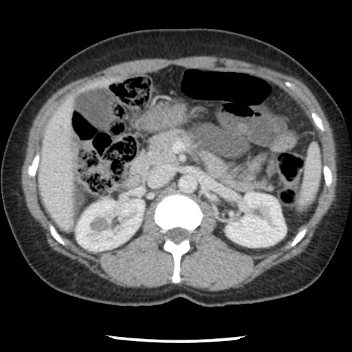File:Closed loop small bowel obstruction due to trans-omental herniation (Radiopaedia 35593-37109 A 34).jpg