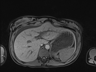 Closed loop small bowel obstruction in pregnancy (MRI) (Radiopaedia 87637-104031 Axial T1 fat sat 26).jpg