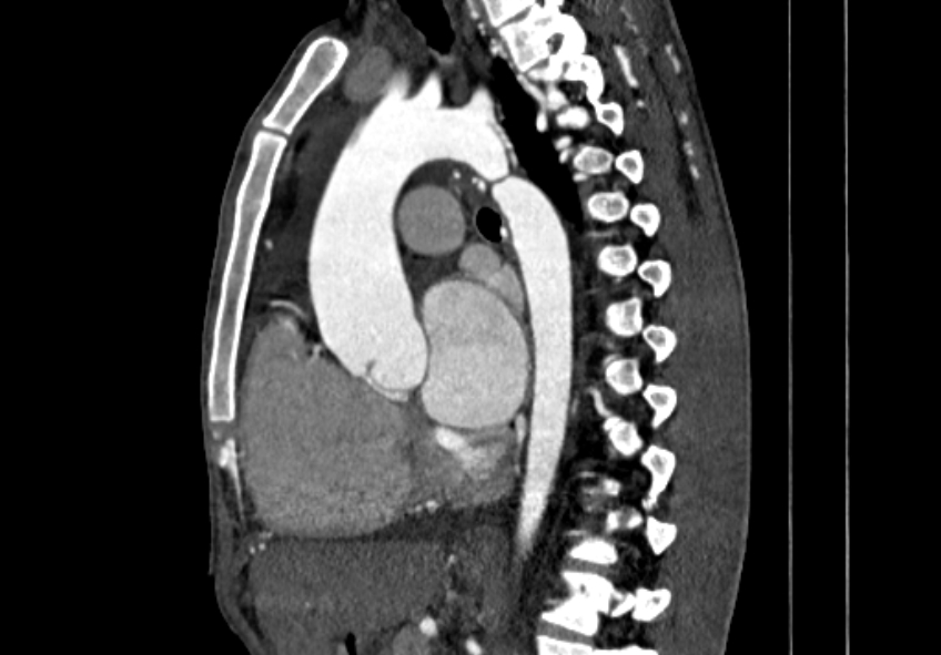 Coarctation of aorta with aortic valve stenosis (Radiopaedia 70463-80574 B 73).jpg
