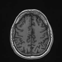 File:Cochlear incomplete partition type III associated with hypothalamic hamartoma (Radiopaedia 88756-105498 Axial T1 143).jpg