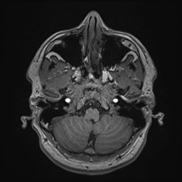 File:Cochlear incomplete partition type III associated with hypothalamic hamartoma (Radiopaedia 88756-105498 Axial T1 47).jpg