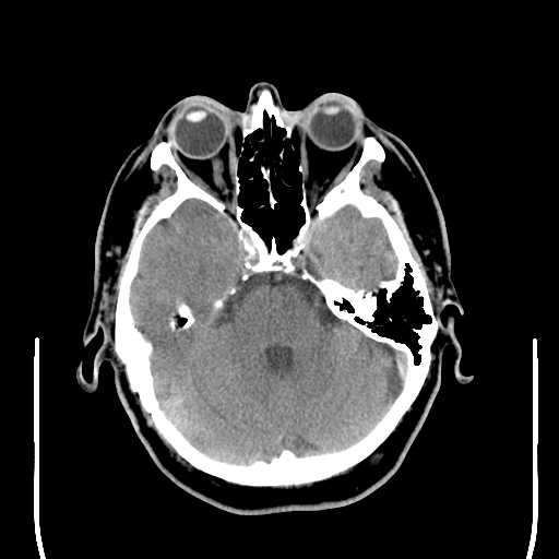 File:Colloid cyst (large) (Radiopaedia 34415-35734 Axial non-contrast 19).png