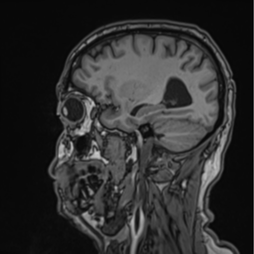 File:Colloid cyst of the third ventricle (Radiopaedia 86571-102662 Sagittal T1 55).png