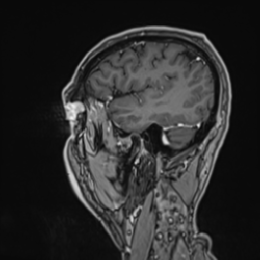 Colloid cyst of the third ventricle (Radiopaedia 86571-102662 Sagittal T1 C+ 16).png