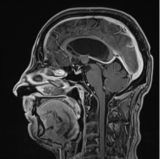 File:Colloid cyst of the third ventricle (Radiopaedia 86571-102662 Sagittal T1 C+ 39).png