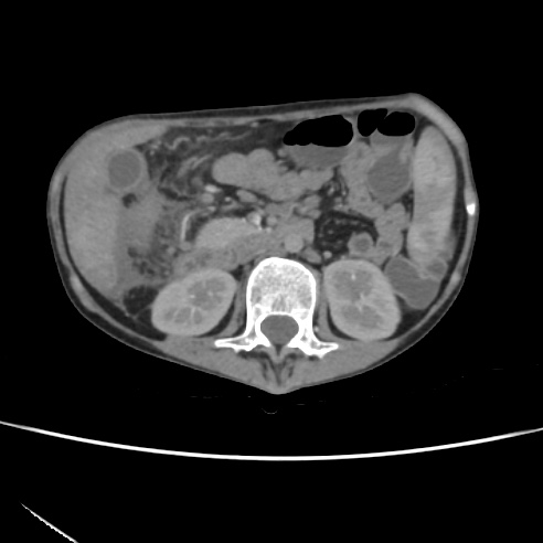 File:Colocolic fistula - Crohn disease (Radiopaedia 57063-63955 A 31).jpg