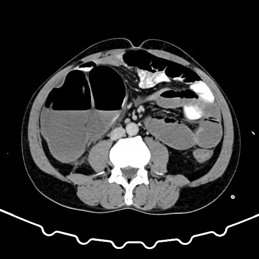 File:Colocolic intussusception due to large lipoma (Radiopaedia 68773-78482 Axial 100).jpg