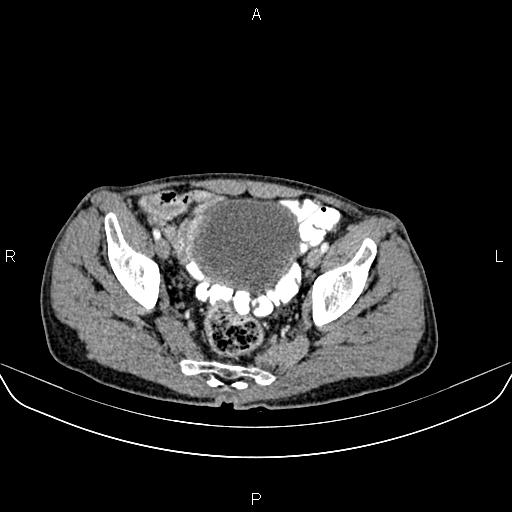 File:Colon adenocarcinoma - hepatic flexure (Radiopaedia 85635-101395 A 83).jpg