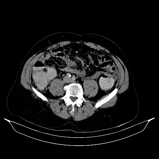 Colonic diverticulosis (Radiopaedia 72222-82744 A 64).jpg