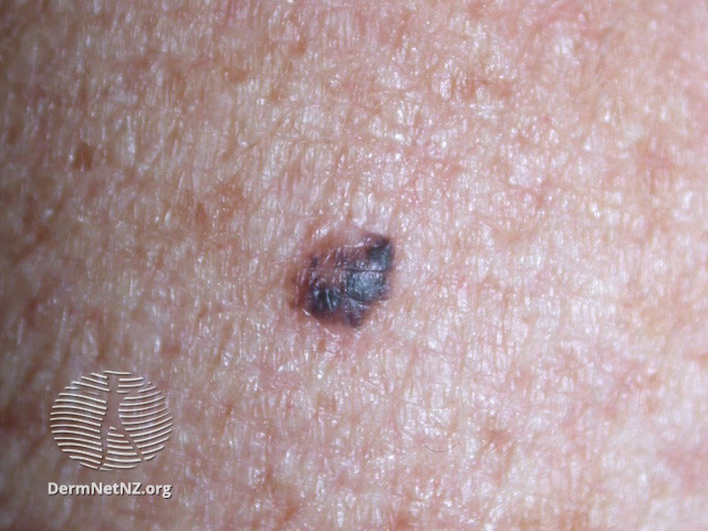 Intraepidermal carcinoma (DermNet NZ lesions-scc-in-situ-2926).jpg