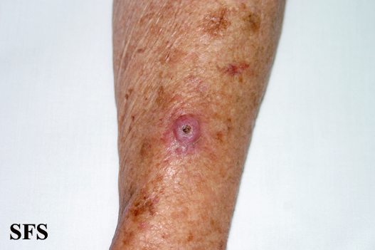 File:Keratoacanthoma (Dermatology Atlas 52).jpg