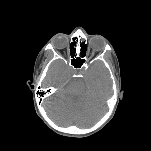 File:Nasal pyogenic granuloma (lobular capillary hemangioma) (Radiopaedia 85536-101244 Axial non-contrast 99).jpg