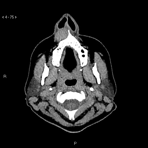 File:Nasolabial cyst (Radiopaedia 75125-86194 Axial non-contrast 37).jpg