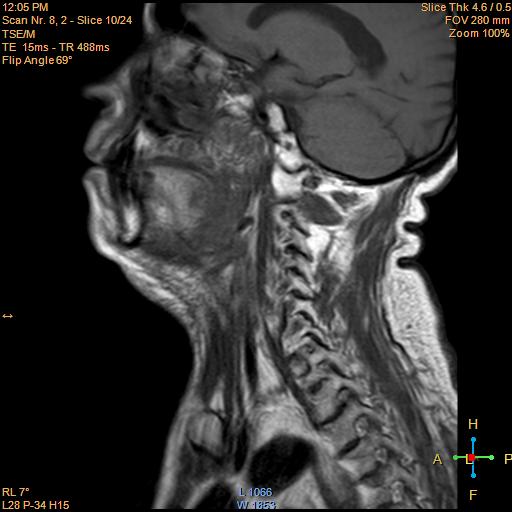 File:Nasopharyngeal carcinoma (Radiopaedia 22375-22403 Sagittal T1 5).jpg