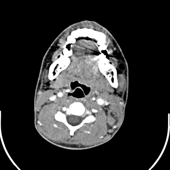 File:Nasopharyngeal carcinoma with skull base invasion (Radiopaedia 53415-59705 A 112).jpg