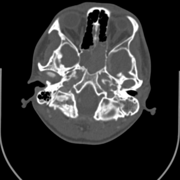 Nasopharyngeal carcinoma with skull base invasion (Radiopaedia 53415-59705 Axial bone window 21).jpg