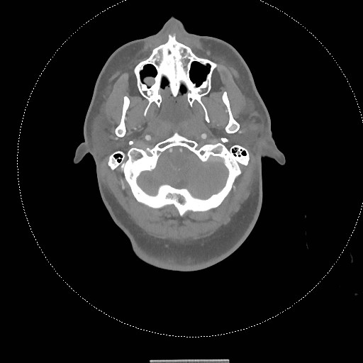 Neck CT angiogram (intraosseous vascular access) (Radiopaedia 55481-61945 B 251).jpg