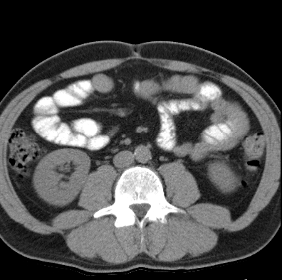 File:Necrotizing pancreatitis with acute necrotic collection (Radiopaedia 14470-14417 Axial non-contrast 29).jpg