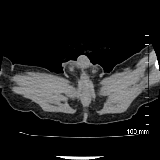 File:Neonatal neuroblastoma (Radiopaedia 56651-63438 Axial non-contrast 89).jpg