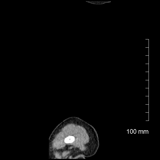 File:Neonatal neuroblastoma (Radiopaedia 56651-63438 C 4).jpg