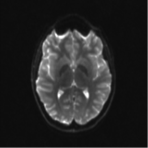 Neurenteric cyst (Radiopaedia 58641-65837 Axial DWI 19).png