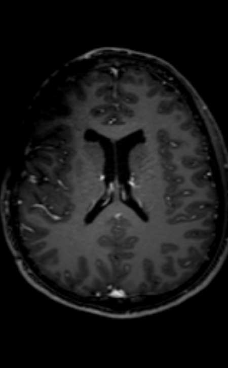 Neuro-Behçet disease (Radiopaedia 90112-107294 Axial T1 C+ 112).jpg
