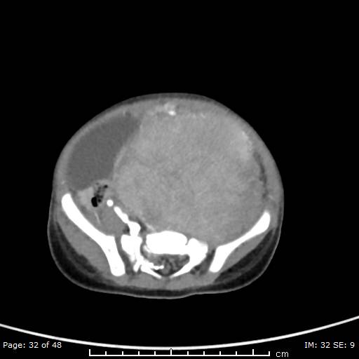 File:Neuroblastoma (Radiopaedia 41472-44355 A 32).jpg