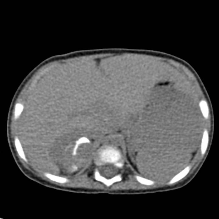 Neuroblastoma with skull metastases (Radiopaedia 30326-30960 Axial non-contrast 15).jpg