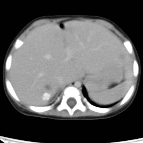 Neuroblastoma with skull metastases (Radiopaedia 30326-30960 C 9).jpg