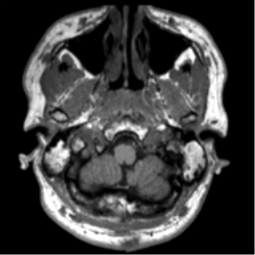 File:Neurofibromatosis type 2 (Radiopaedia 44936-48838 Axial T1 9).png