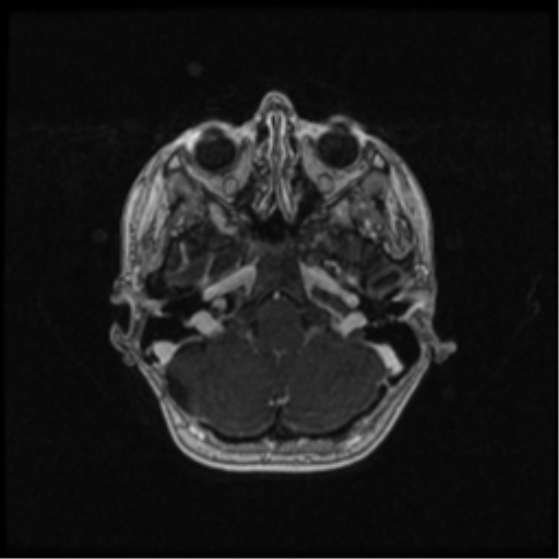 Neurofibromatosis type 2 (Radiopaedia 45229-49244 Axial T1 C+ 35).png