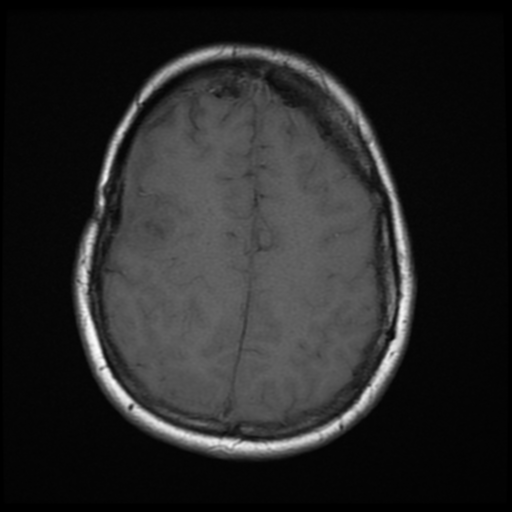 File:Neurofibromatosis type 2 (Radiopaedia 45229-49247 Axial T1 17).png