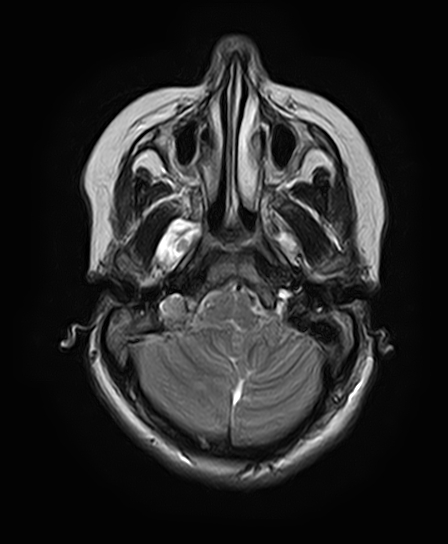 File:Neurofibromatosis type 2 (Radiopaedia 66211-75401 Axial T2 9).jpg