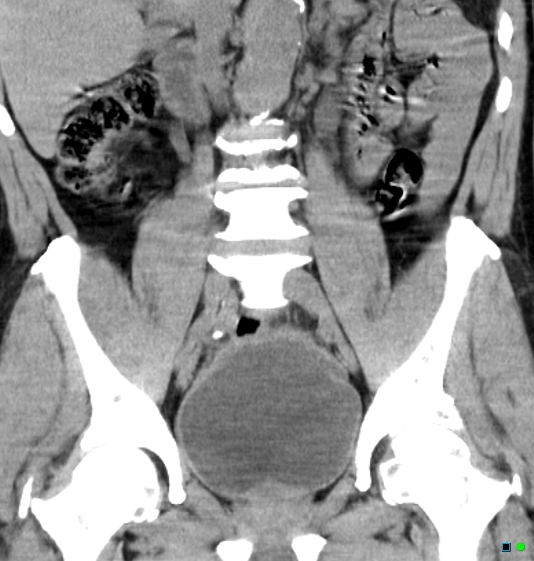 File:Neurogenic bladder - CT findings (Christmas tree bladder) (Radiopaedia 26995-27174 Coronal non-contrast 10).jpg