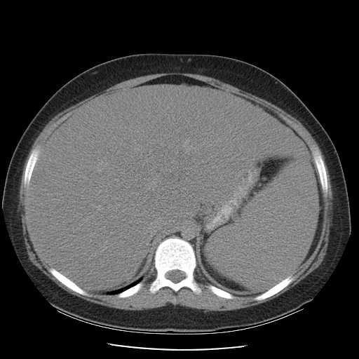 File:Non-Hodgkin lymphoma involving pelvis (Radiopaedia 21281-21197 B 18).jpg