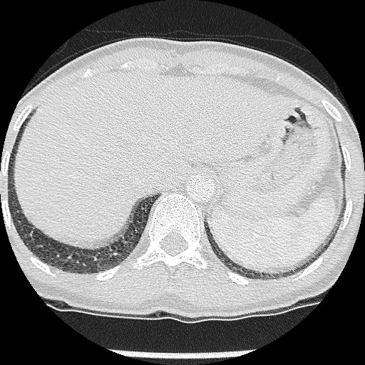 File:Non-small cell lung cancer with miliary metastases (Radiopaedia 23995-24193 Axial lung window 22).jpg